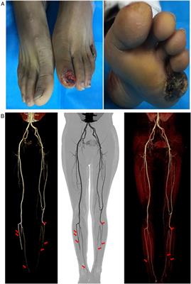 An improved bone transport surgical method for treating chronic ischemic ulcers (thromboangiitis obliterans)